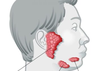 Salivary Gland Cancer