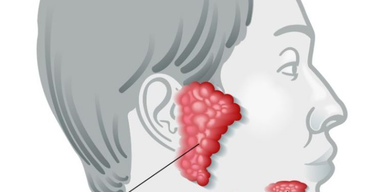 Salivary Gland Cancer