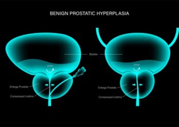 prostate cancer