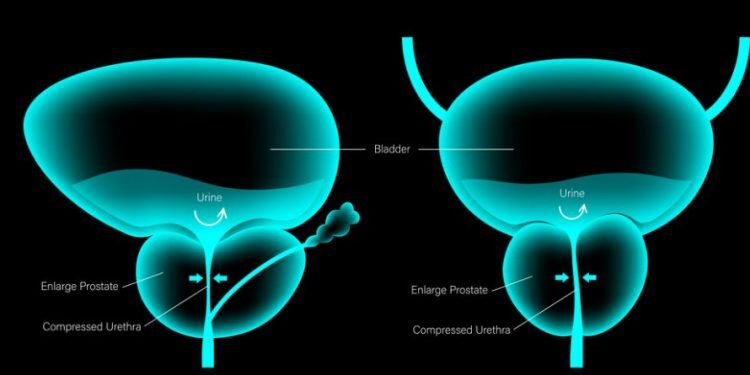 prostate cancer