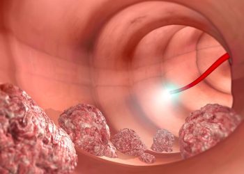 Colon Cancer