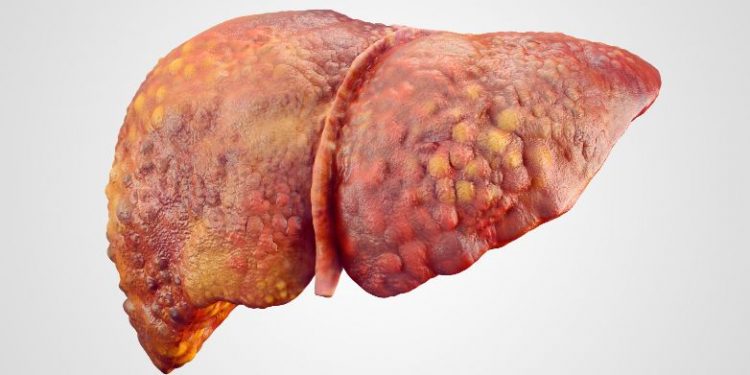 “I Am Cancer-Free” | Stage 4 Liver Cancer