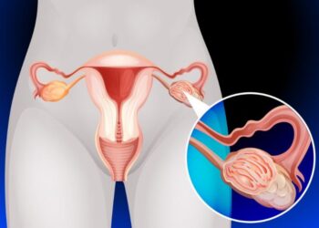 Ovarian cancer