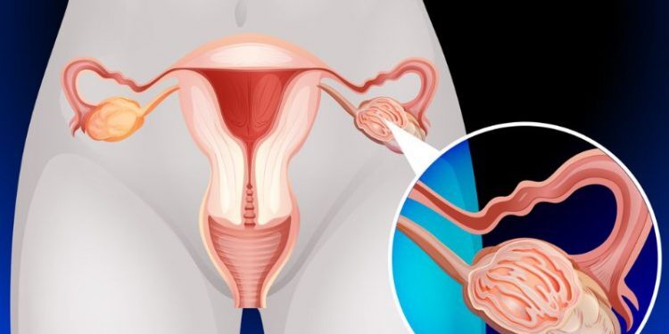 Ovarian cancer