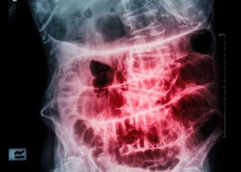 Small Intestine Cancer