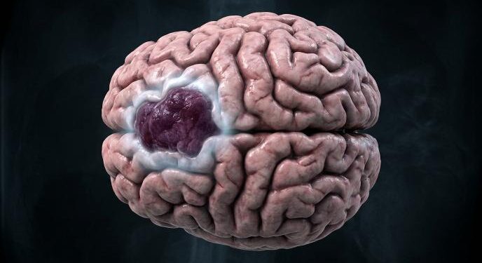 Glioma Brain Cancer